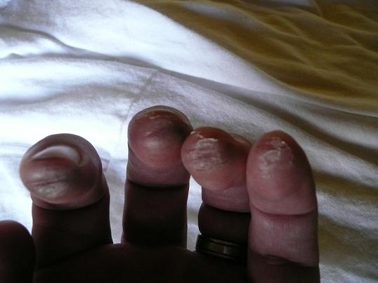 Image:Hammerfingers.jpg